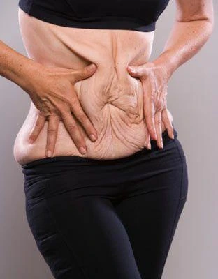 Liposuction Görsel