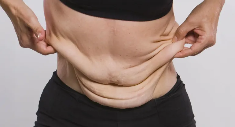 Abdominoplasti Görsel